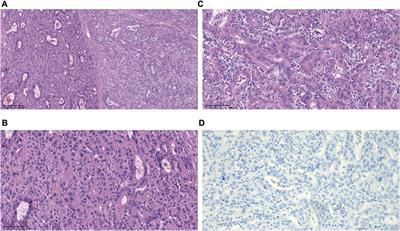 Case report: Remarkable response to sintilimab, lenvatinib, and nab-paclitaxel in postoperative metastatic chemotherapy-resistant combined hepatocellular-cholangiocarcinoma